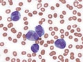 Acute promyelocytic leukemia in peripheral blood. Royalty Free Stock Photo