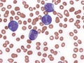 Acute promyelocytic leukemia in peripheral blood. Royalty Free Stock Photo