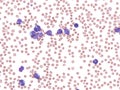 Acute promyelocytic leukemia in peripheral blood. Royalty Free Stock Photo