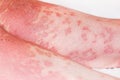 Large red,inflamed,scaly rash on man's legs.Acute psoriasis, severe reddening of the skin,an autoimmune,incurable
