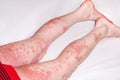 Large red,inflamed,scaly rash on man& x27;s legs.Acute psoriasis, severe reddening of the skin,an autoimmune,incurable