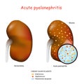 Acute pyelonephritis