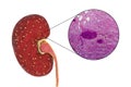 Acute pyelonephritis, gross morphology and histopathology