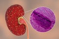 Acute pyelonephritis, gross morphology and histopathology