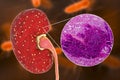 Acute pyelonephritis, gross morphology and histopathology