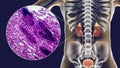 Acute pyelonephritis, gross morphology and histopathology