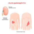 Acute pyelonephritis. Inflammation of the kidney