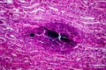 Acute pyelonephritis, light micrograph