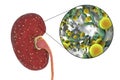 Acute pyelonephritis, medical concept, and close-up view of bacteria