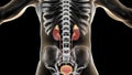 Acute pyelonephritis, medical concept