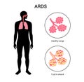 ARDS anatomical poster