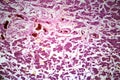 Acute severe hepatitis, light micrograph