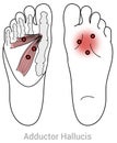 Adductor hallucis myofascial trigger points may cause pain in the metatarsals . Royalty Free Stock Photo