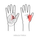 Adductor pollicis: Trigger point thumb pain