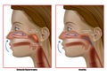 Adenoid hypertrophy, the abnormal growth of the pharyngeal tonsils. Adenoidectomy. Eustachian Tube Dysfunction Royalty Free Stock Photo
