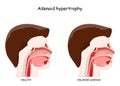 Adenoid hypertrophy