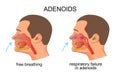 Adenoiditis, respiratory failure