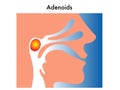 Adenoids