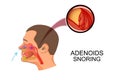 Adenoids cause snoring Royalty Free Stock Photo