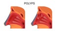 Adenoids in nose