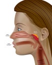 Adenoids, pharyngeal tonsil or nasopharyngeal tonsil Otolaryngology Adenoid hypertrophy