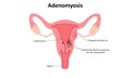 Adenomyosis vector illustration Royalty Free Stock Photo