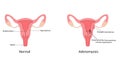 Adenomyosis vector illustration Royalty Free Stock Photo