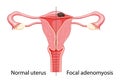 Adenomyosis Focal Human anatomy Female reproductive Sick system vs versus normal Compared educational healthy abnormal