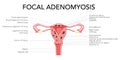 Adenomyosis Focal with inscriptions, Human anatomy Female reproductive Sick system organs. Structure of uterus, ovary