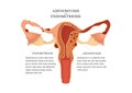 Adenomyosis vs endometriosis. Anatomical illustration of the female reproductive system with symptoms of adenomyosis