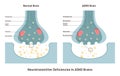 ADHD brain concept. Attention deficit hyperactivity disorder, neurotransmitters