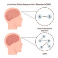 ADHD brain concept. Attention deficit hyperactivity disorder way