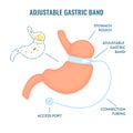 Adjustable gastric band bariatric surgery weight loss infographics