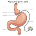 Adjustable gastric band diagram medical science