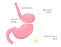 Adjustable gastric band on stomach. Human anatomy illustration for infographics, atlas, textbook or study material.