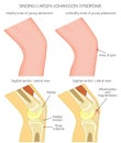 Adolescent knee pain_Sinding Larsen Johansson Syndrome