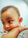 Adorable baby with skin allergy on the face. Reactions to the dusts, foods and environment