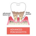 periodontal pocket and bone destruction. destroyed bone cause teeth to become loose and fall out. Dental and oral care concept.