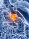 Adrenal gland cancer Royalty Free Stock Photo