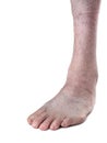 Adult male with club foot aka talipes, despite childhood intervention. On white. Royalty Free Stock Photo