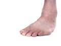 Adult male with club foot aka talipes, despite childhood intervention. Closeup, on white. Royalty Free Stock Photo