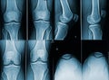 Adult male knees x-ray image. Medical and human anatomy imagery