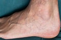 Adult mans foot with varicose veins Royalty Free Stock Photo