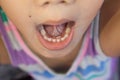 Adult permanent teeth coming in behind baby teeth