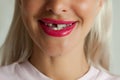 Adult woman with broken front tooth smiling Royalty Free Stock Photo