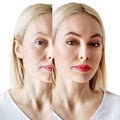 Woman with acne before and after treatment and makeup. Royalty Free Stock Photo