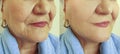 Adult woman wrinkles removalface lift beautician before and effect correction after treatment