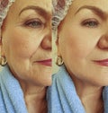 Adult woman wrinkles removalface lift therapy beautician before and effect correction after treatment