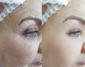 Adult woman wrinkles removal skin collagen therapy hydrating effect regeneration treatment before and after treatment Royalty Free Stock Photo