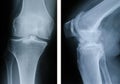 Advanced osteoarthritis